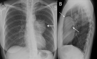 Imaging Evaluation of Thymoma and Thymic Carcinoma